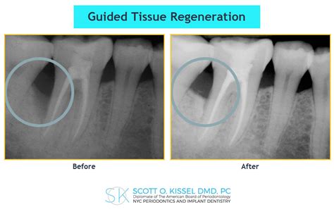 guided tissue regeneration las vegas